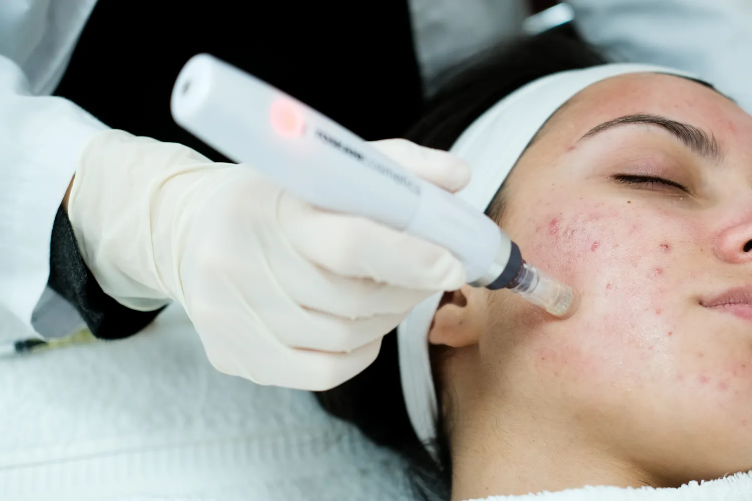 Yvonne Hefft - Kosmetikstudio - MICRONEEDLING